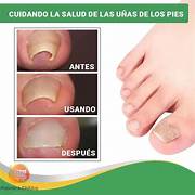 ⭐ Parches Correctores Uñas Enterradas™ – Tratamiento No Invasivo y Efectivo en Casa